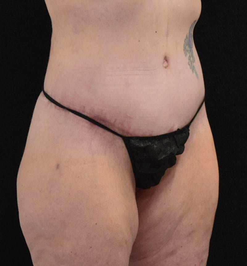 Lower Body Lift Before & After Gallery - Patient 102567856 - Image 4