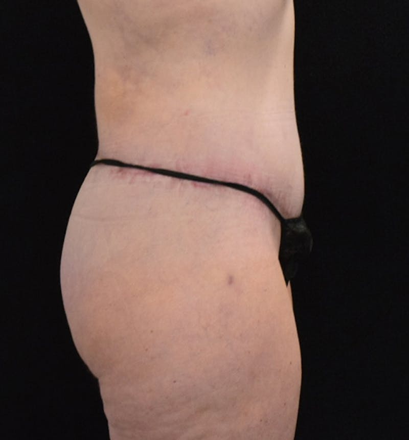 Lower Body Lift Before & After Gallery - Patient 102567856 - Image 6