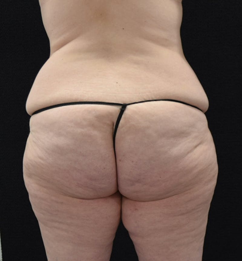 Lower Body Lift Before & After Gallery - Patient 102567856 - Image 7