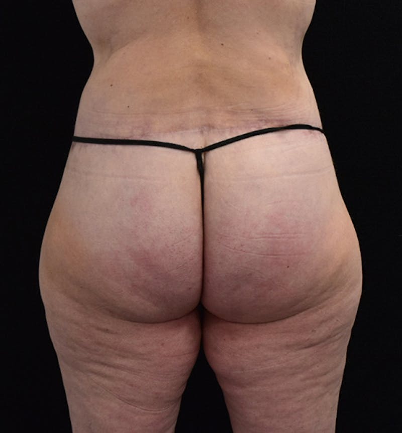 Lower Body Lift Before & After Gallery - Patient 102567856 - Image 8