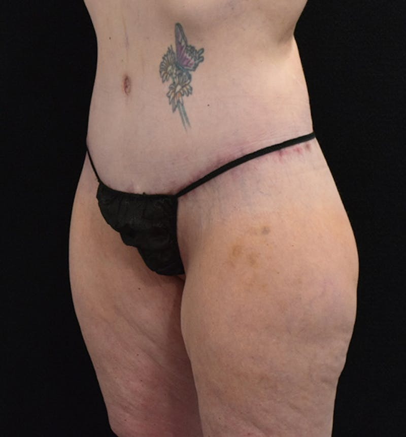 Lower Body Lift Before & After Gallery - Patient 102567856 - Image 10