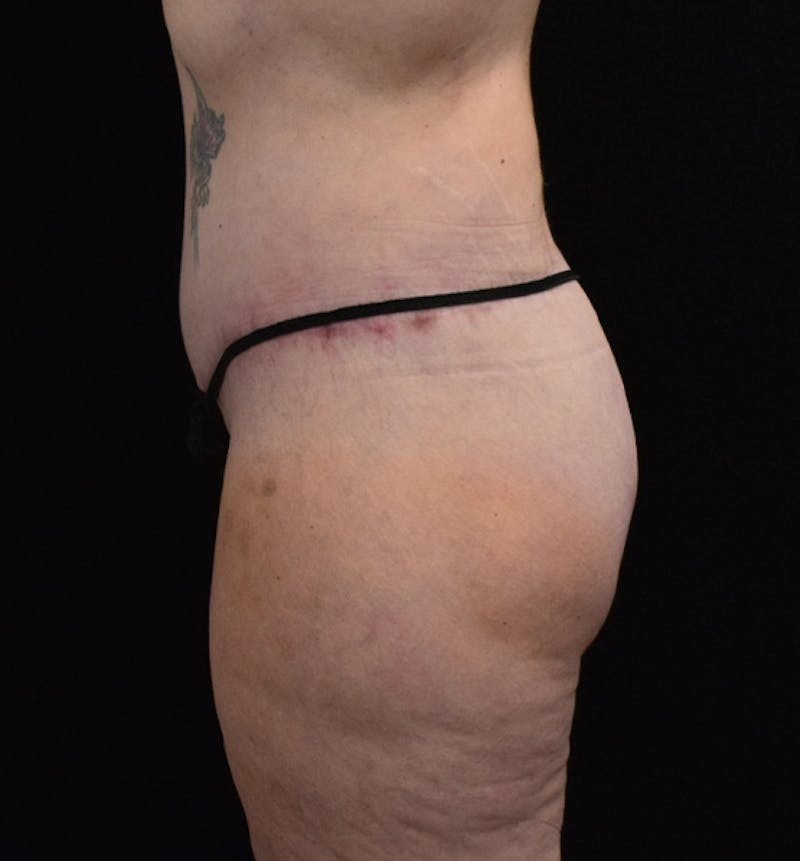 Lower Body Lift Before & After Gallery - Patient 102567856 - Image 12
