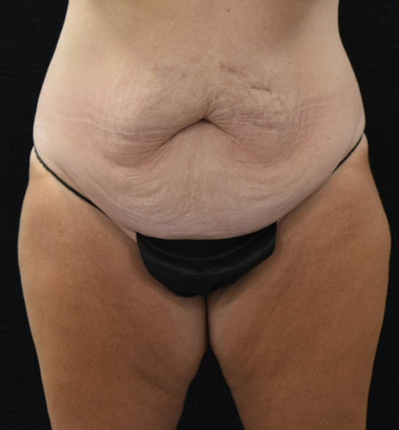 Lower Body Lift Before & After Gallery - Patient 102567895 - Image 1