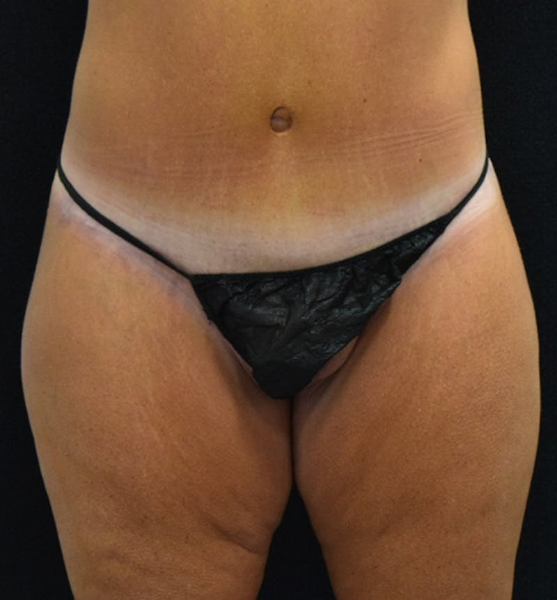 Lower Body Lift Before & After Gallery - Patient 102567895 - Image 2