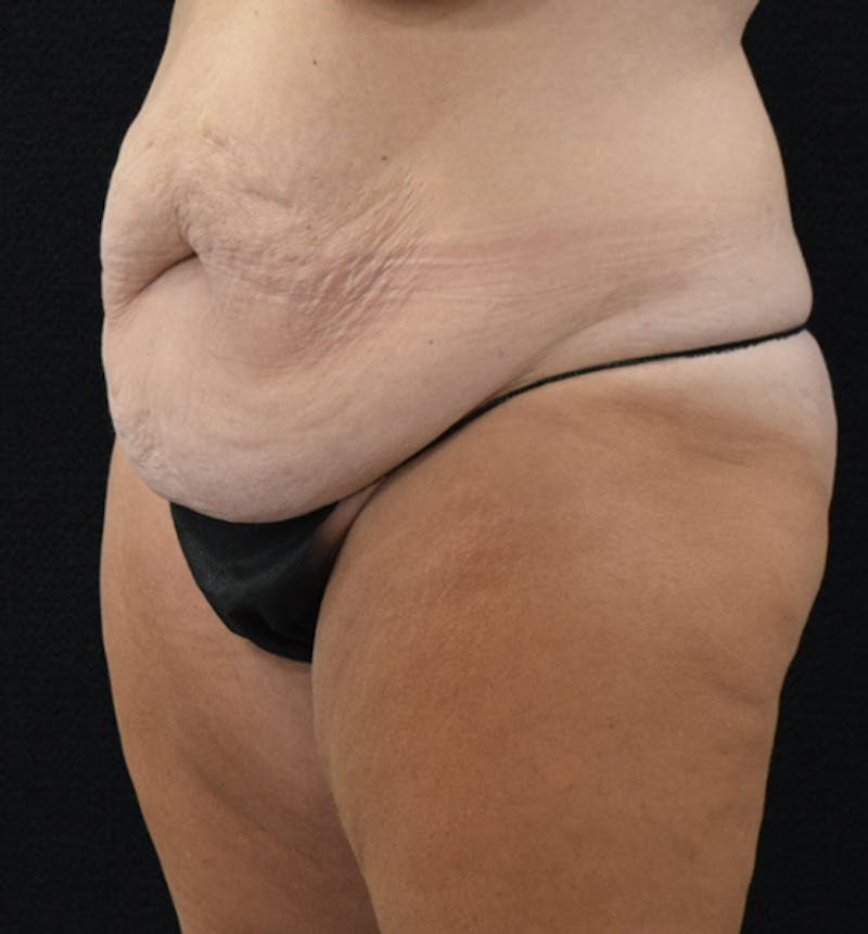Lower Body Lift Before & After Gallery - Patient 102567895 - Image 3