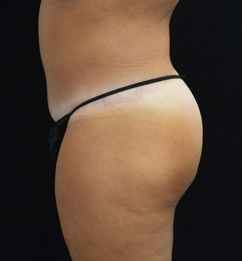Lower Body Lift Before & After Gallery - Patient 102567895 - Image 6