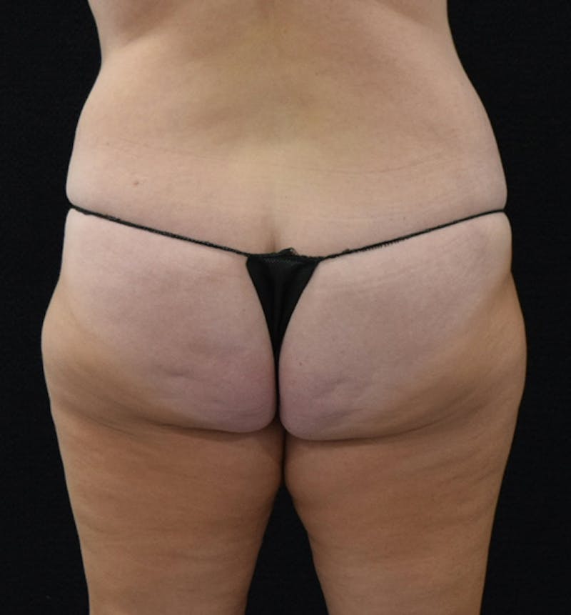 Lower Body Lift Gallery - Patient 102567895 - Image 7