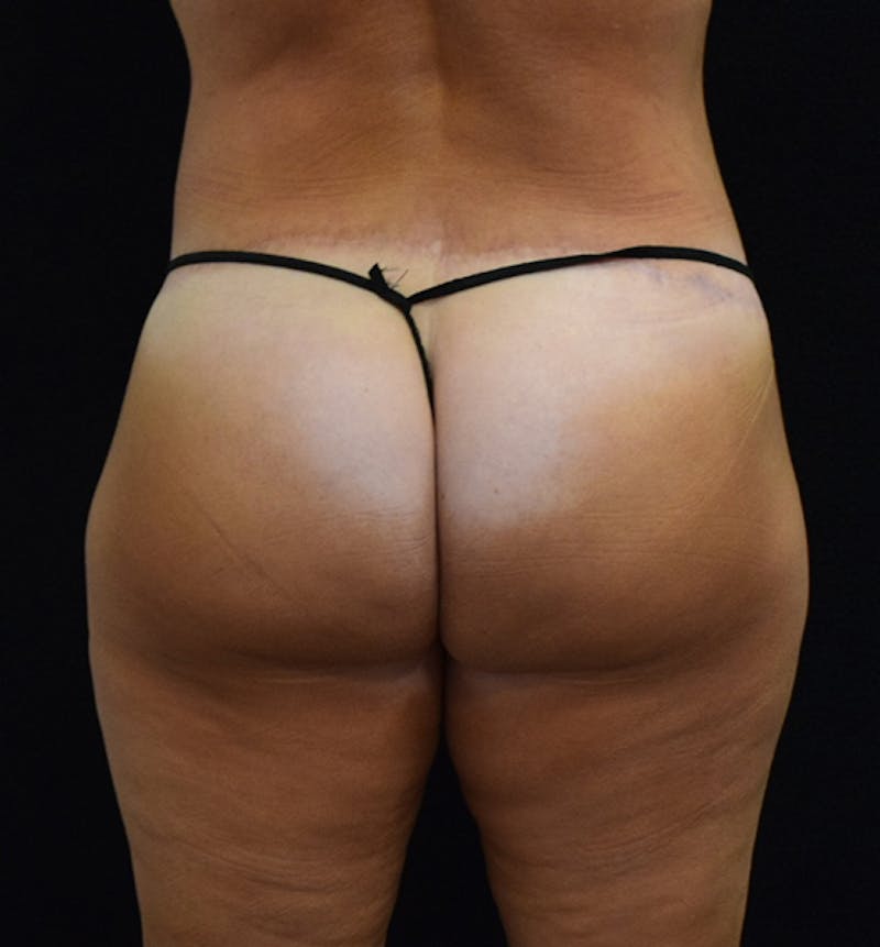 Lower Body Lift Before & After Gallery - Patient 102567895 - Image 8