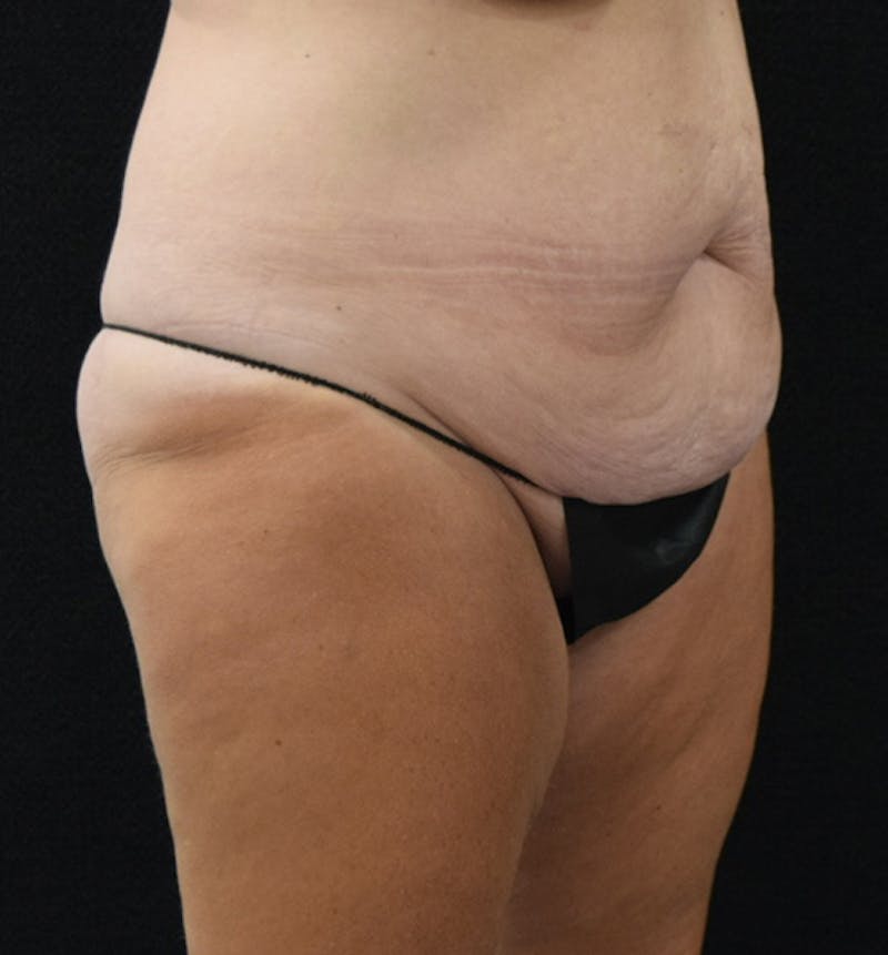 Lower Body Lift Before & After Gallery - Patient 102567895 - Image 9