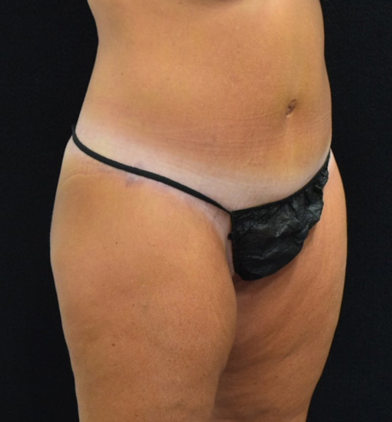 Lower Body Lift Before & After Gallery - Patient 102567895 - Image 10