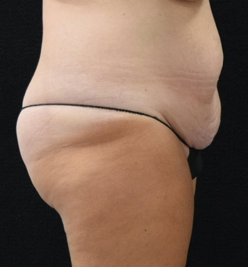 Lower Body Lift Before & After Gallery - Patient 102567895 - Image 11