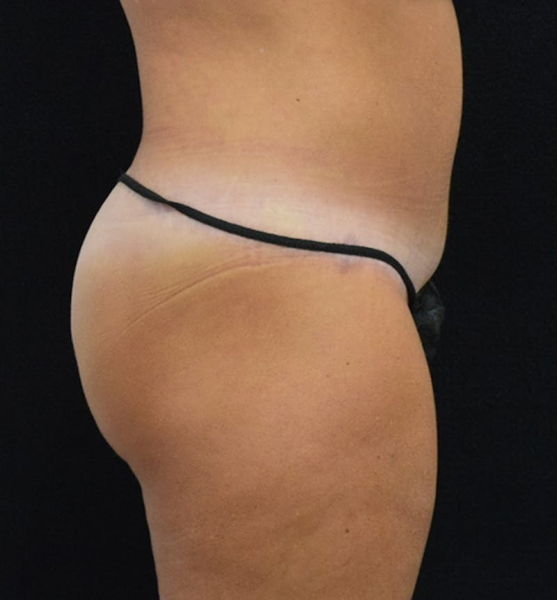 Lower Body Lift Before & After Gallery - Patient 102567895 - Image 12