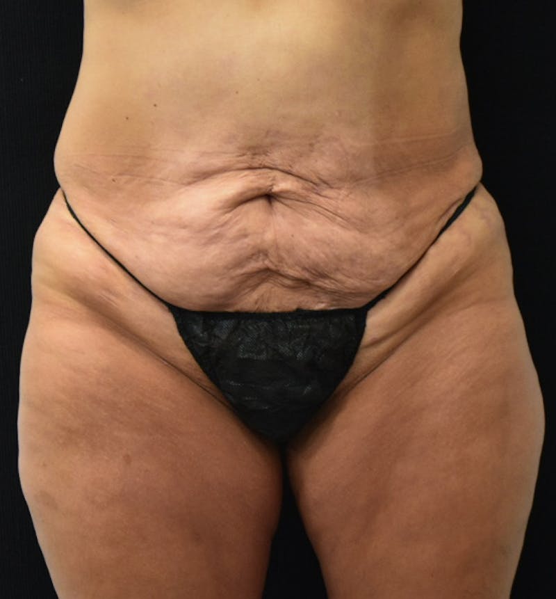 Lower Body Lift Before & After Gallery - Patient 102567932 - Image 1