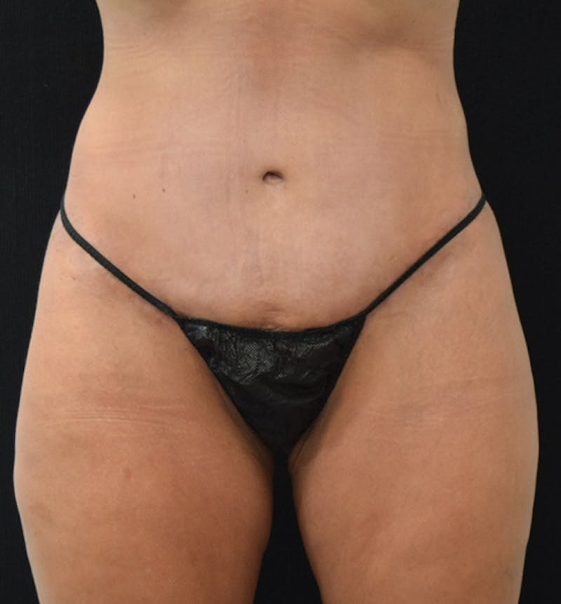 Lower Body Lift Before & After Gallery - Patient 102567932 - Image 2