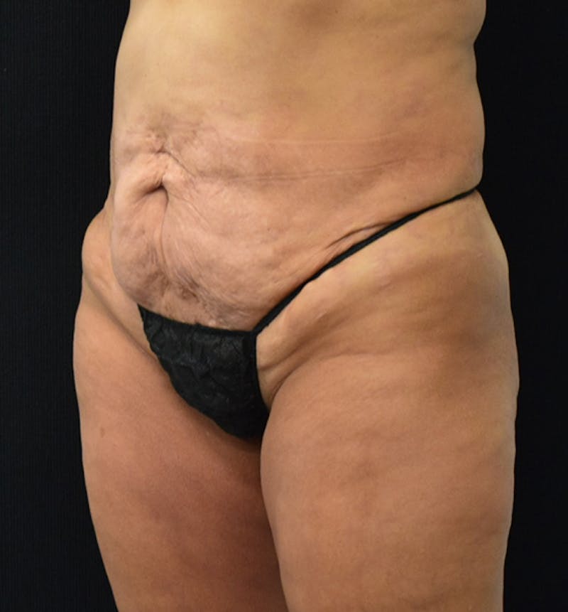 Lower Body Lift Before & After Gallery - Patient 102567932 - Image 3