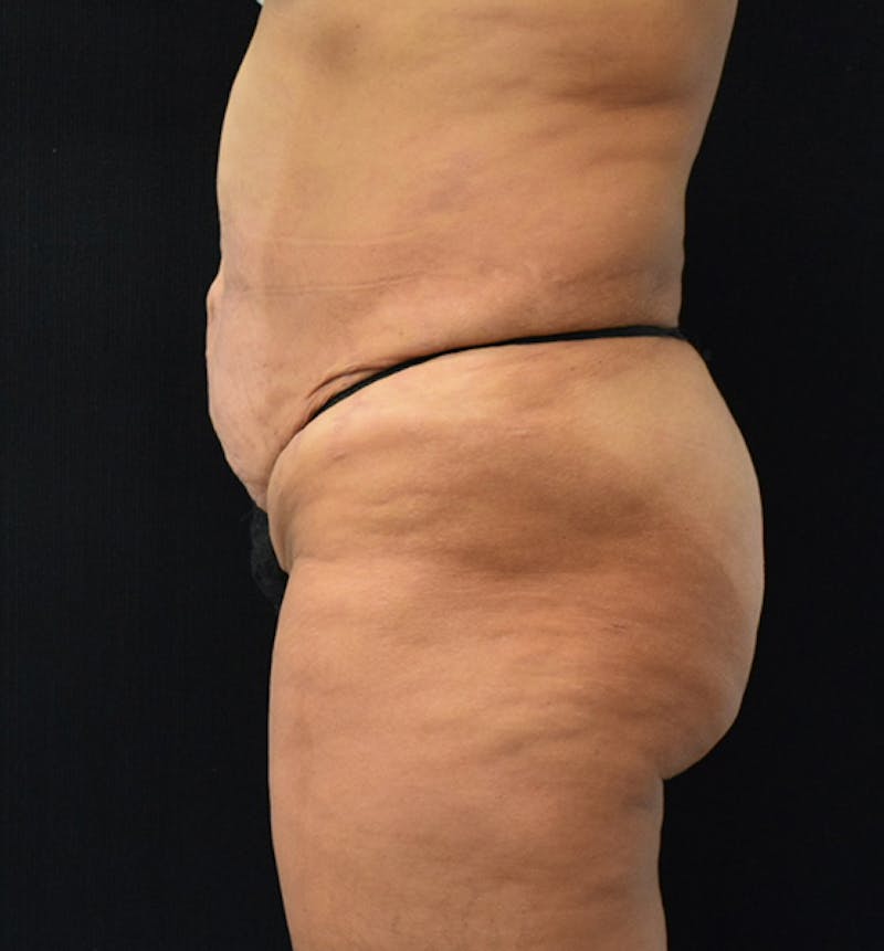 Lower Body Lift Before & After Gallery - Patient 102567932 - Image 5