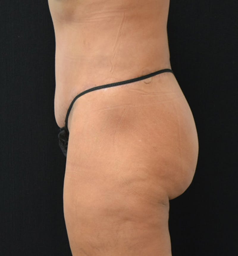 Lower Body Lift Before & After Gallery - Patient 102567932 - Image 6