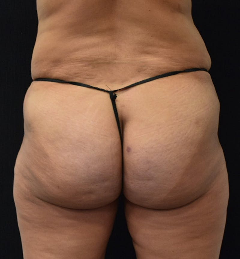 Lower Body Lift Before & After Gallery - Patient 102567932 - Image 7