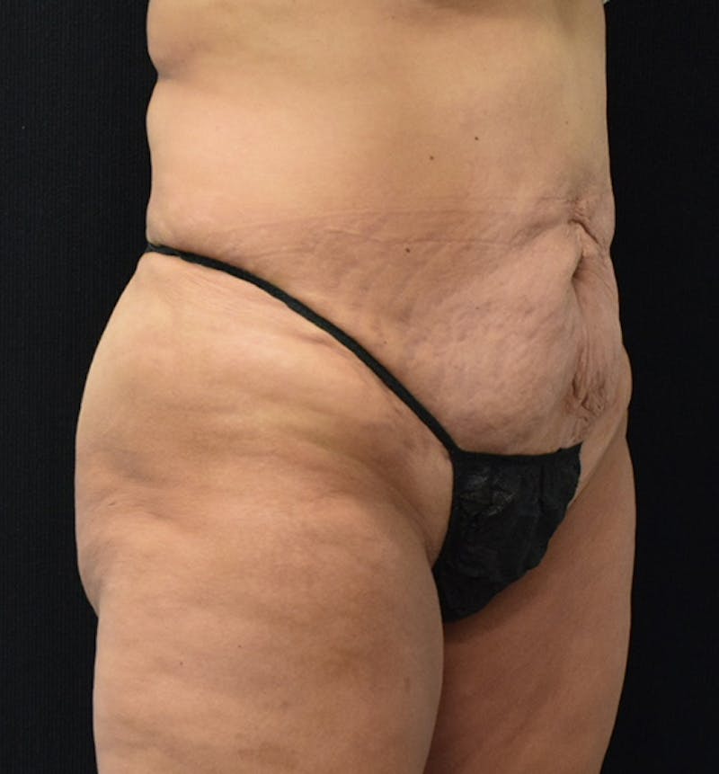 Lower Body Lift Before & After Gallery - Patient 102567932 - Image 9