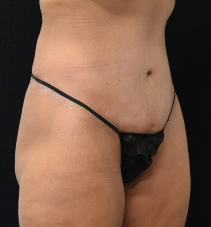 Lower Body Lift Before & After Gallery - Patient 102567932 - Image 10