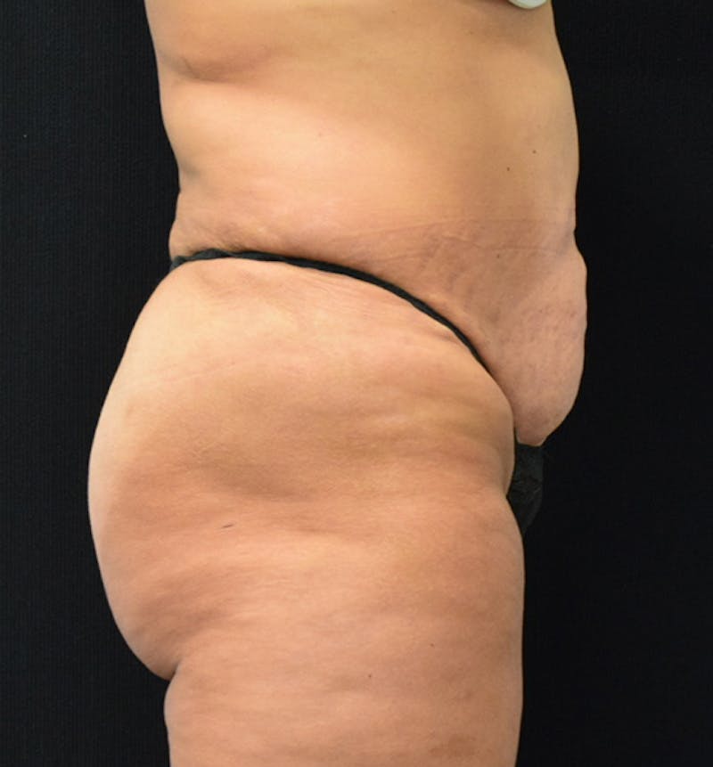 Lower Body Lift Before & After Gallery - Patient 102567932 - Image 11