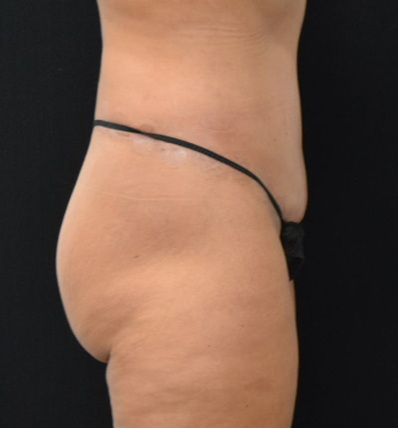 Lower Body Lift Before & After Gallery - Patient 102567932 - Image 12