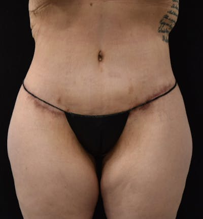 Lower Body Lift Before & After Gallery - Patient 102567941 - Image 2