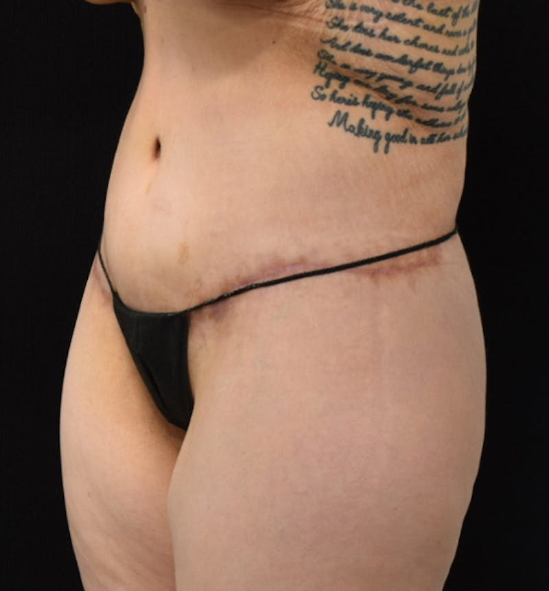 Lower Body Lift Before & After Gallery - Patient 102567941 - Image 4