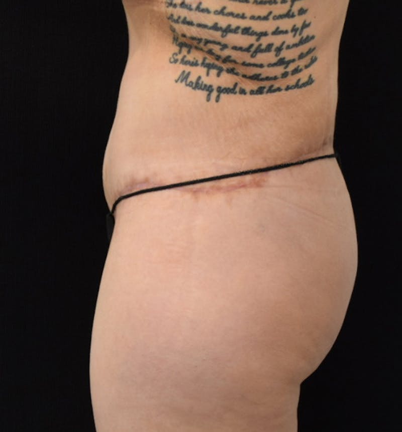 Lower Body Lift Before & After Gallery - Patient 102567941 - Image 6