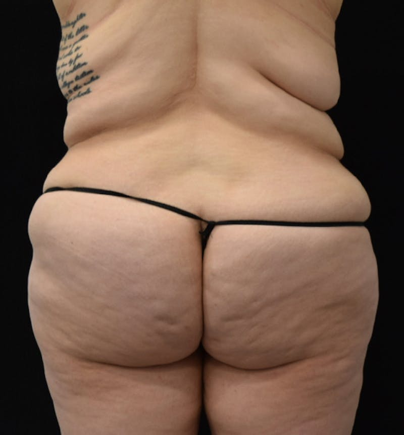 Lower Body Lift Before & After Gallery - Patient 102567941 - Image 7