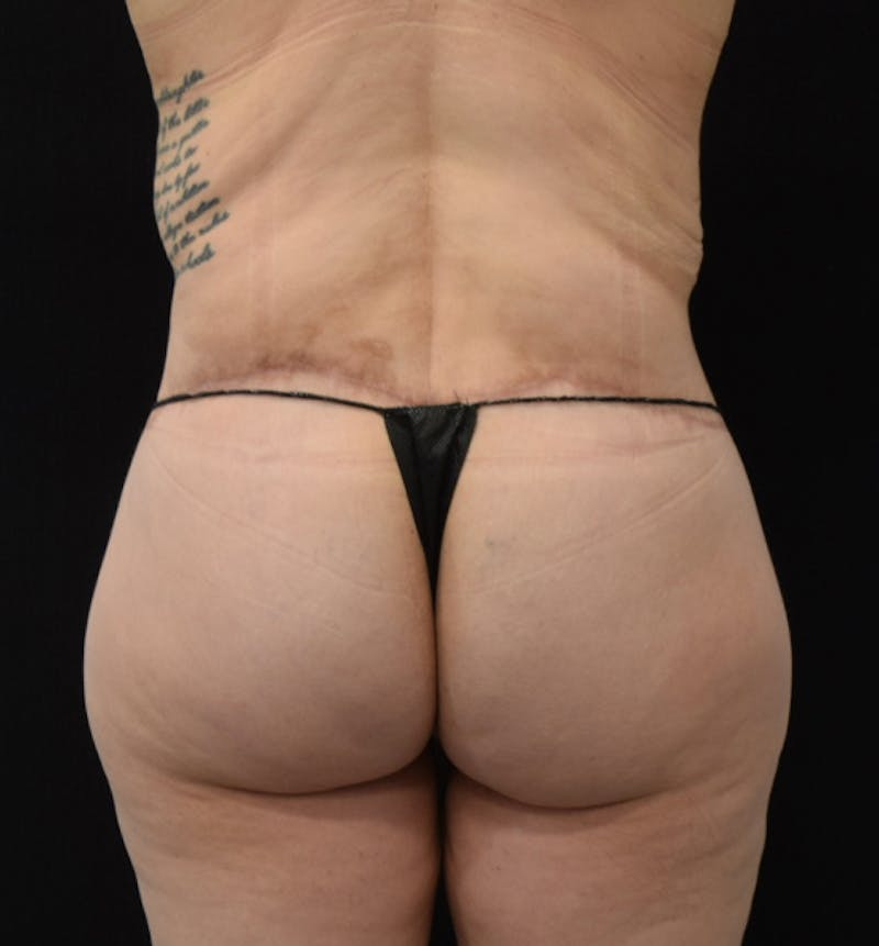 Lower Body Lift Before & After Gallery - Patient 102567941 - Image 8
