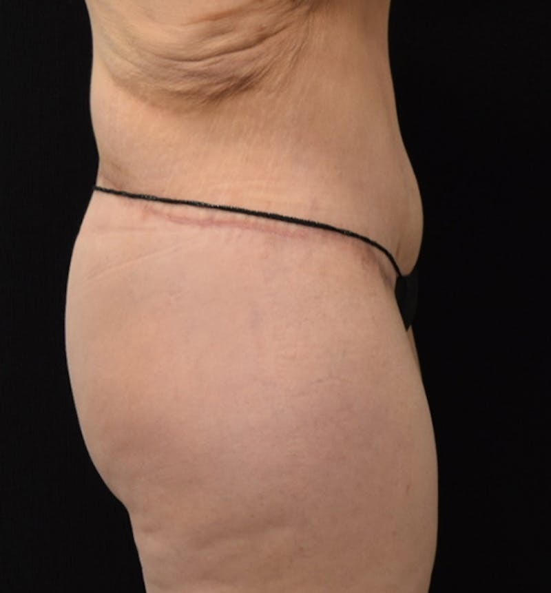 Lower Body Lift Before & After Gallery - Patient 102567941 - Image 10