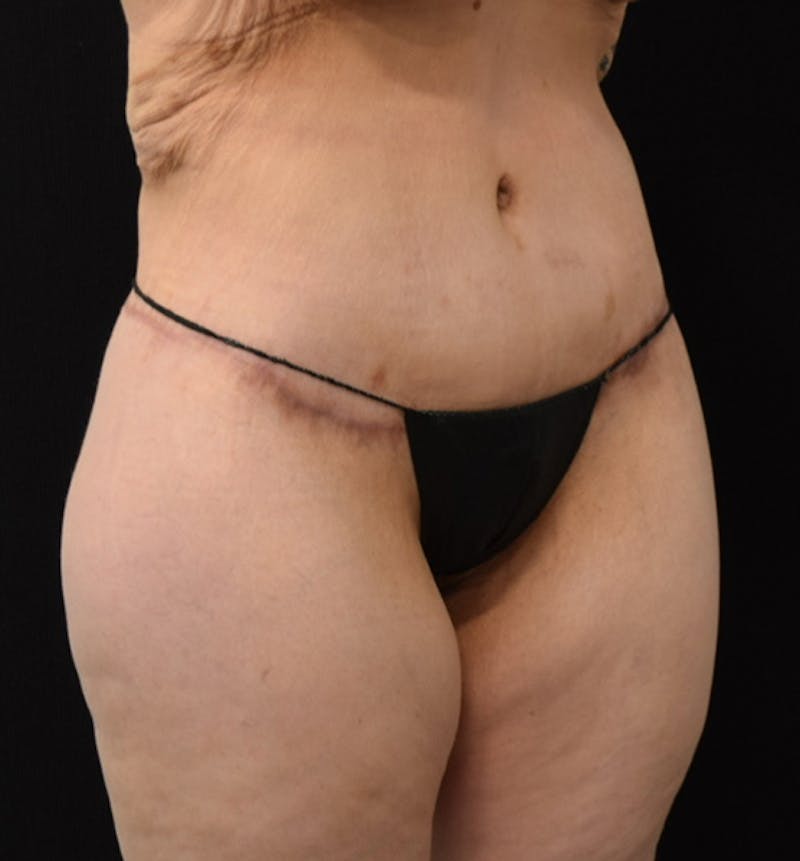 Lower Body Lift Gallery - Patient 102567941 - Image 12