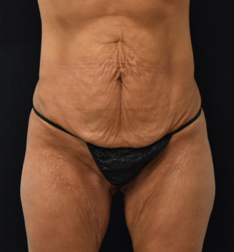 Lower Body Lift Gallery - Patient 102567988 - Image 1
