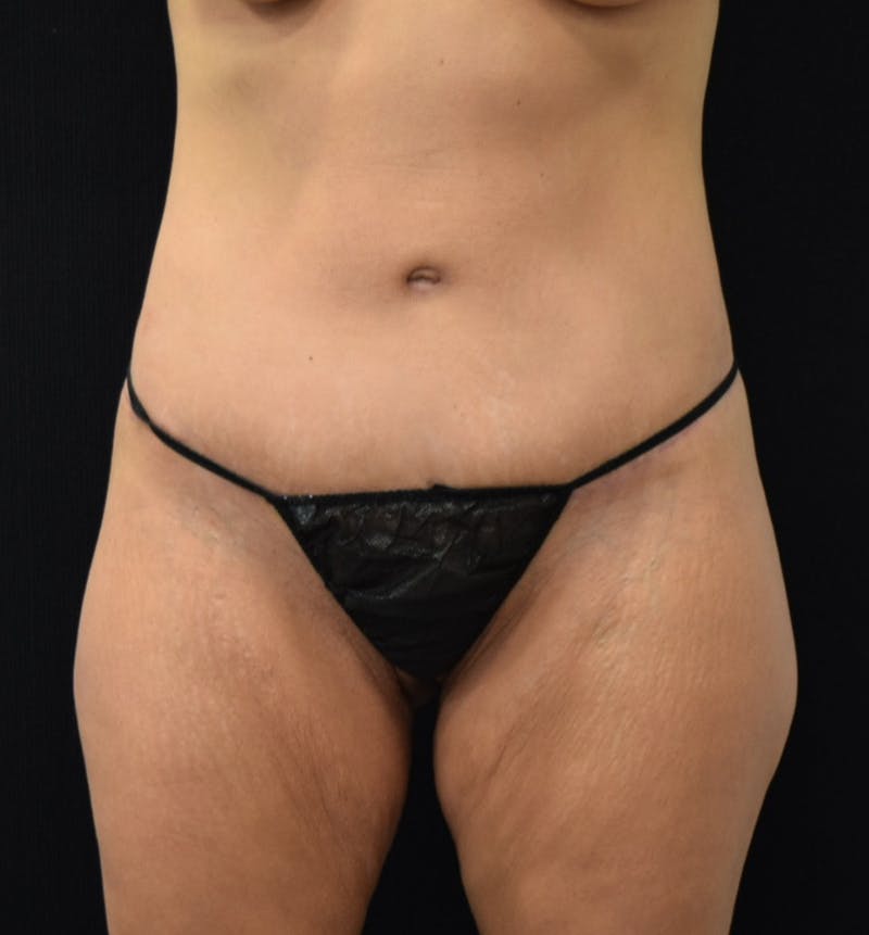 Lower Body Lift Gallery - Patient 102567988 - Image 2