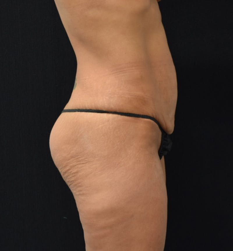 Lower Body Lift Before & After Gallery - Patient 102567988 - Image 9
