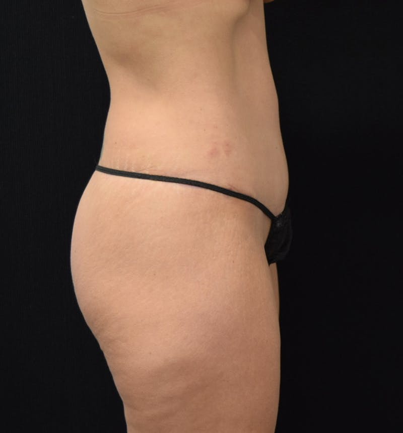 Lower Body Lift Before & After Gallery - Patient 102567988 - Image 10