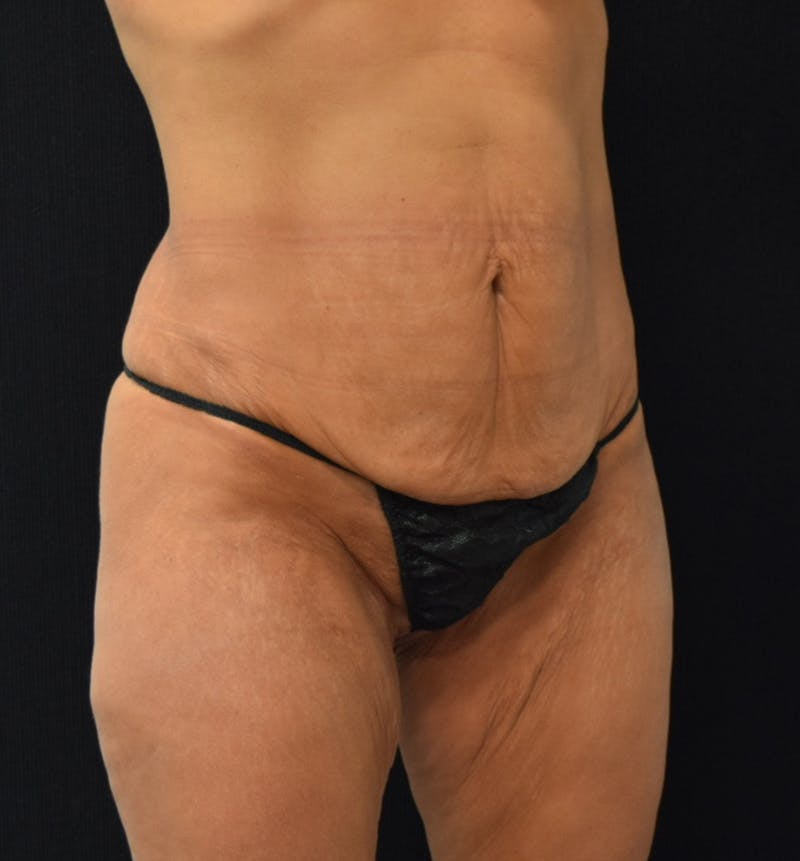Lower Body Lift Before & After Gallery - Patient 102567988 - Image 11