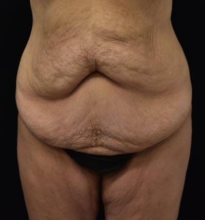 Lower Body Lift Before & After Gallery - Patient 102568008 - Image 1