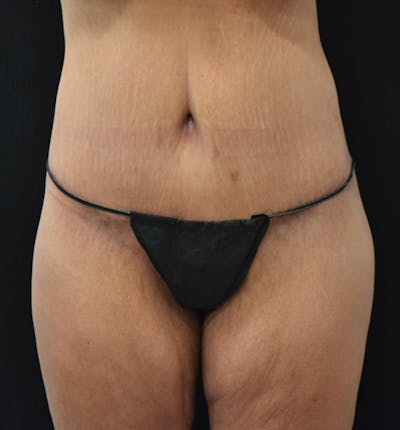 Lower Body Lift Before & After Gallery - Patient 102568008 - Image 2