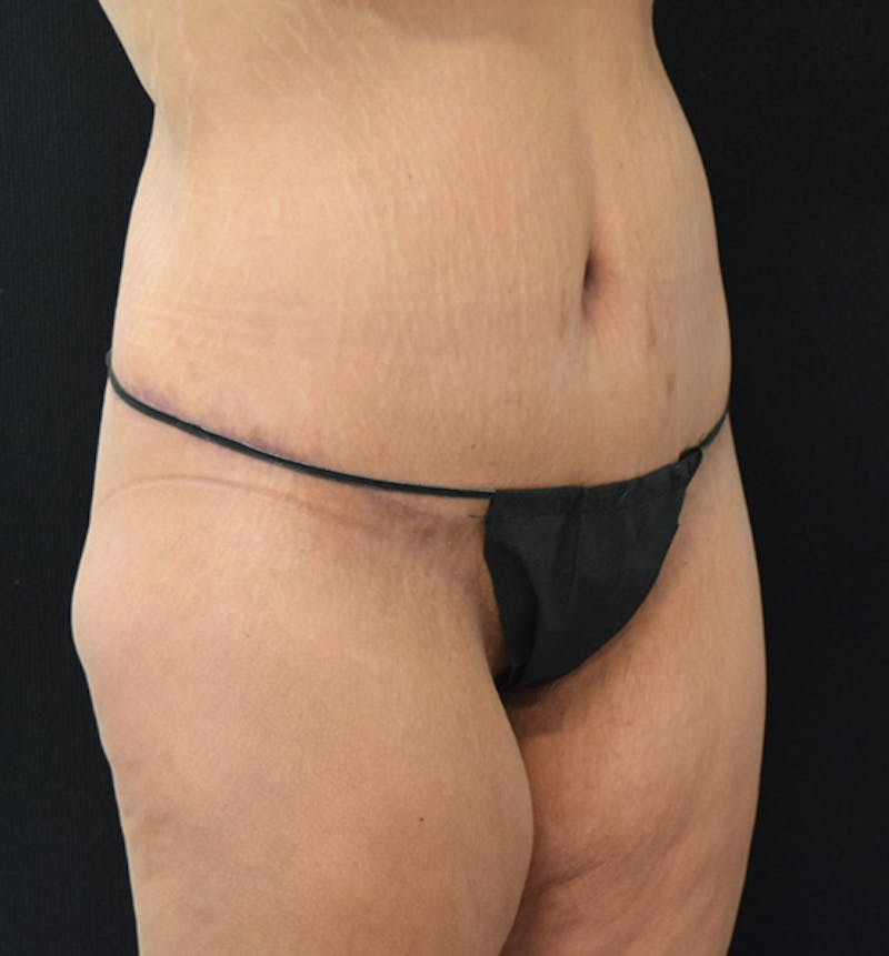 Lower Body Lift Before & After Gallery - Patient 102568008 - Image 4