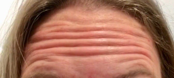 BOTOX