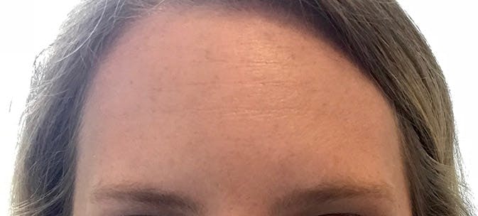 BOTOX