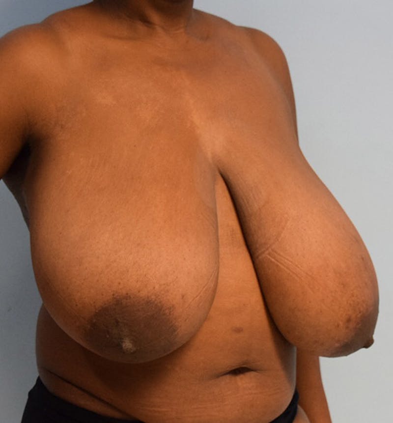 Breast Reduction Before & After Gallery - Patient 102583360 - Image 3