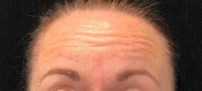 Botox Before & After Gallery - Patient 102583355 - Image 1