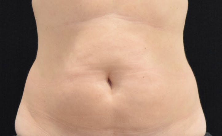 CoolSculpting in Long Island Before & After Photos