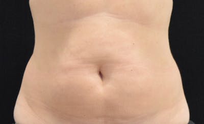 CoolSculpting Gallery - Patient 102583358 - Image 1