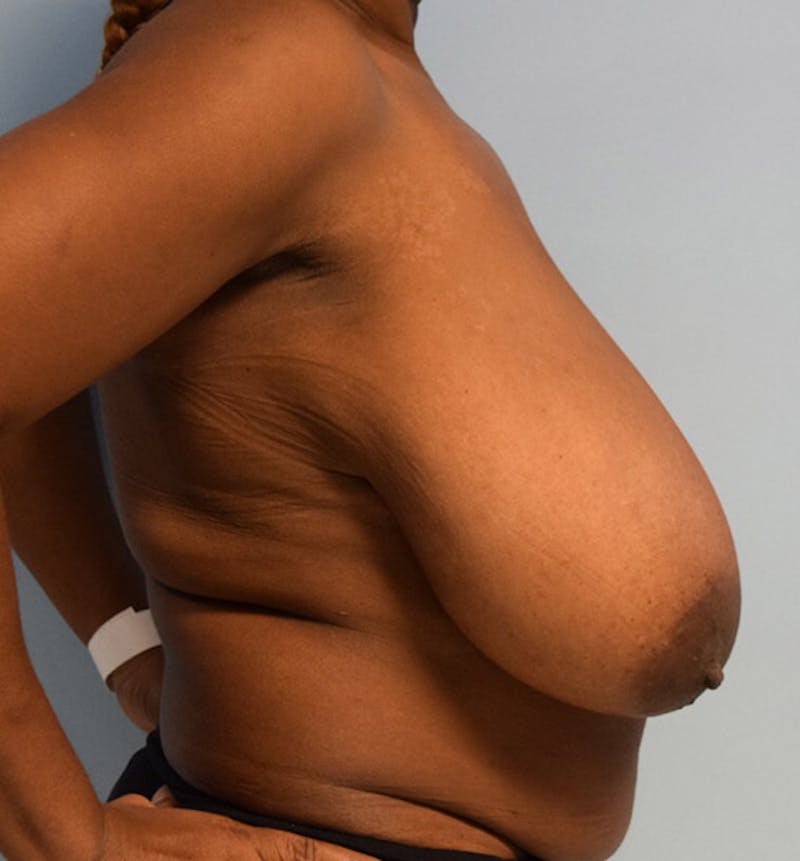 Breast Reduction Before & After Gallery - Patient 102583360 - Image 5