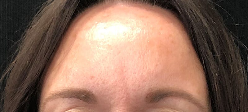 Botox Before & After Gallery - Patient 102583355 - Image 2