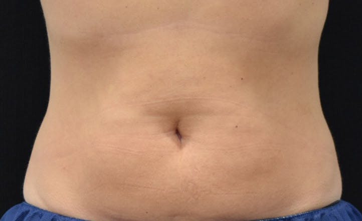 CoolSculpting